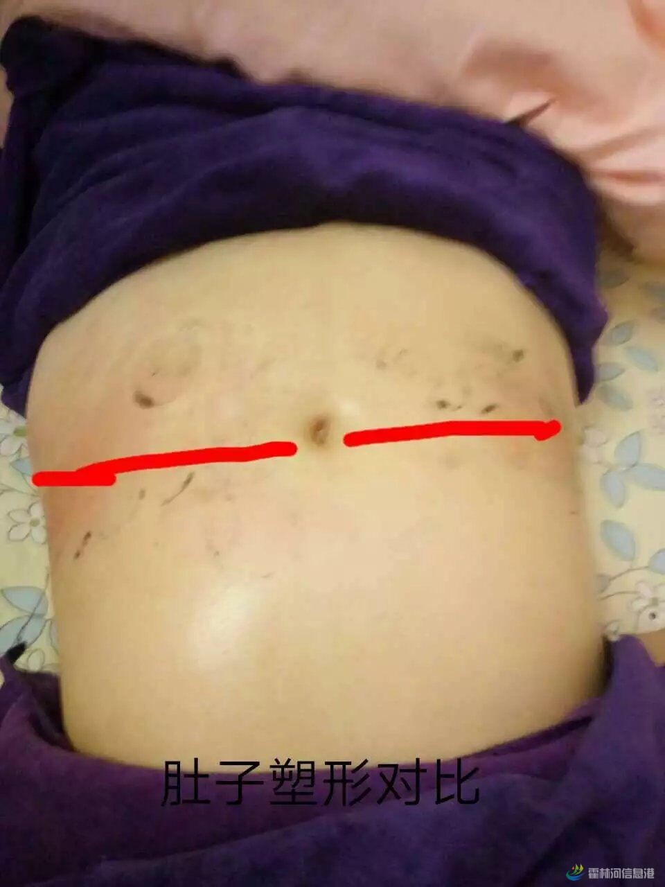 腰部塑形左右对比